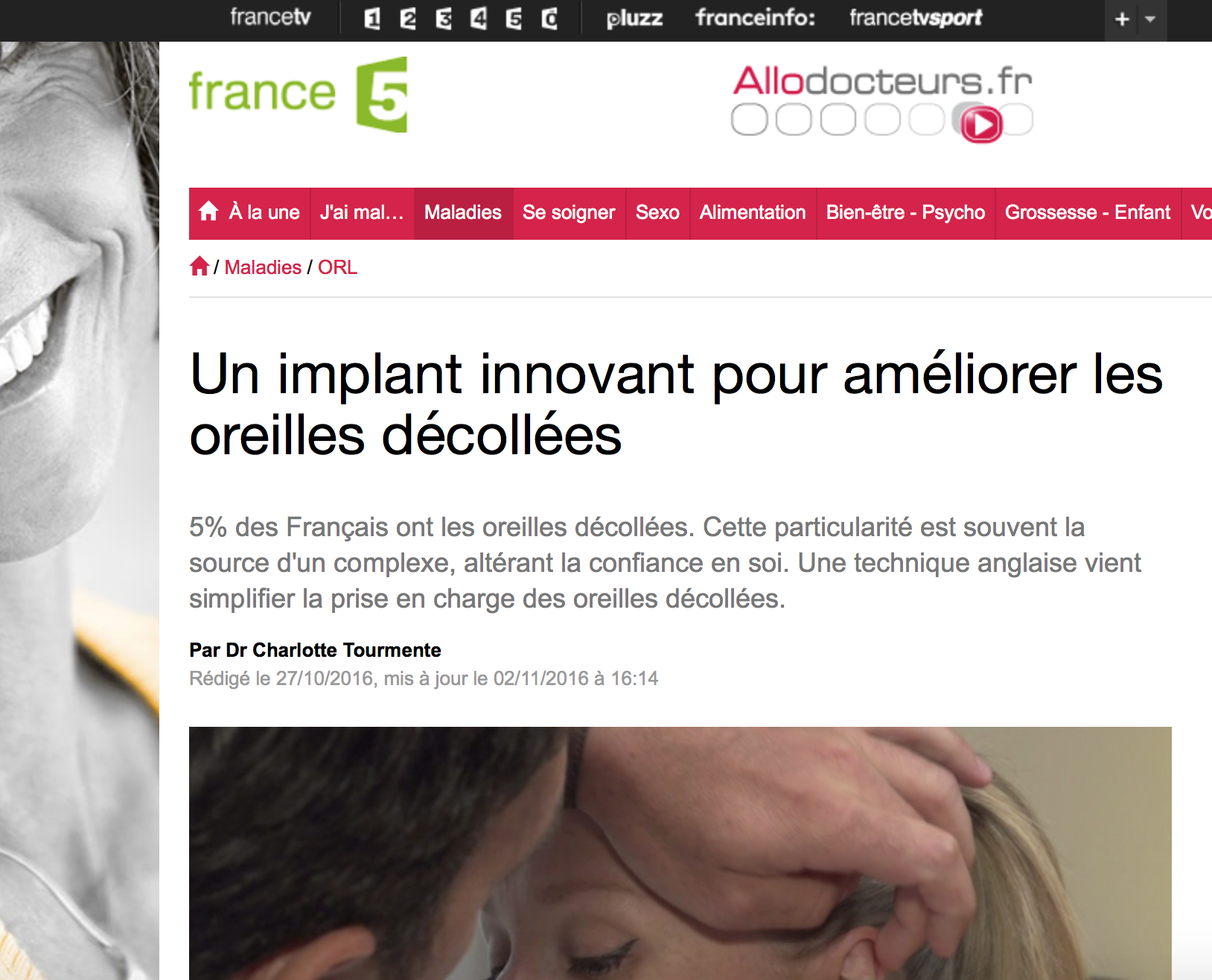 Earfold : l'implant Innovant pour recoller les oreilles décollées