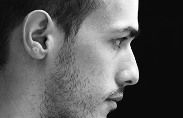 Reconstruction de l'oreille par cartilage costal chez l'homme - Dr Marchac Paris 16