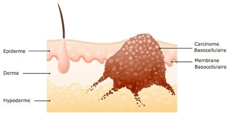 Les cancers cutanés (carcinomes basocellulaires) par le Dr Marchac, Paris 16