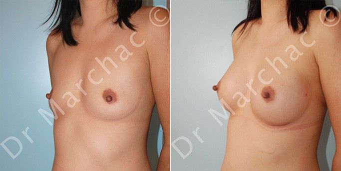 Photo avant/après augmentation mammaire à Paris par le Dr Marchac
