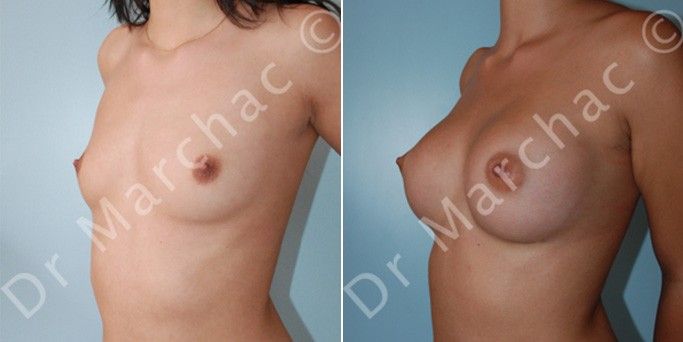 Avant/après correction de l'hypotrophie mammaire par augmentation mammaire