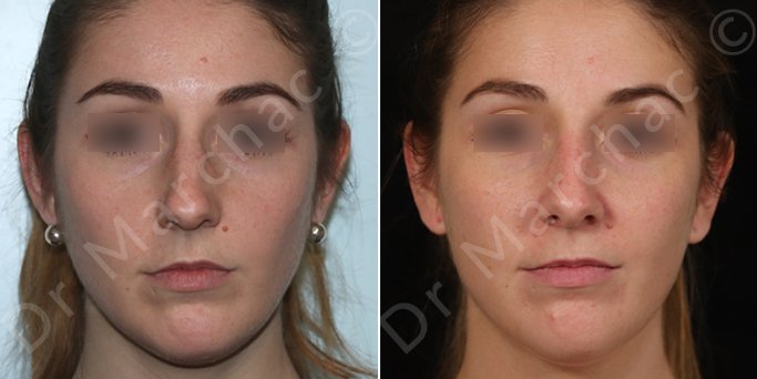 Photos avant/après 3 d'une rhinoplastie chirurgicale du Dr Marchac à Paris 16